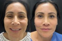 45-54 year old woman treated with Facelift, SMAS Facelift