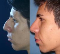 18-24 year old man treated with Rhinoplasty