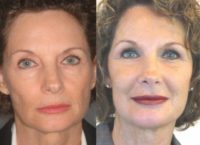55-64 year old woman treated with Non Surgical Face Lift - FAMI Technique