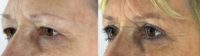 65-74 year old woman treated with Eyelid Surgery