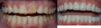 35-44 year old woman treated with Smile Makeover