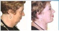 55-64 year old woman treated with Facelift