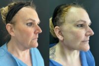 45-54 year old woman treated with Facelift