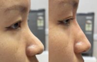 Woman treated with Dermal Filler