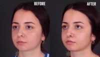 Woman treated with Lip Lift