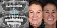 65-74 year old woman treated with All-on-4 Dental Implants, Dental Implants
