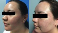 25-34 year old woman treated with TCA Peel