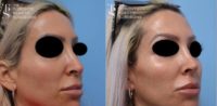 35-44 year old woman treated with Rhinoplasty