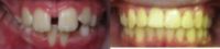Traditional Braces to correct moderate upper and lower spacing, deep overbite