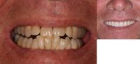 All on 4 Dental Implant Bridges - Teeth in a Day