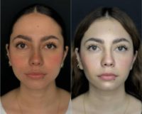 Woman treated with Facelift