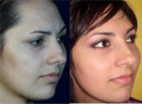 18-24 year old woman treated with Rhinoplasty