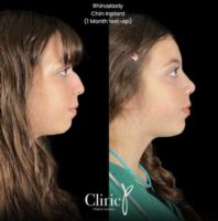 18-24 year old woman treated with Rhinoplasty, Chin Implant