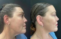 35-44 year old woman treated with Facelift