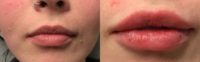25-34 year old woman with Lip Filler Enhancement with 1cc Juvaderm Vollure