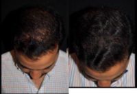 25-34 year old man treated with Hair Loss Treatment