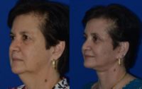 55-64 year old woman treated with Facelift, Necklift, Platysmaplasty, Browlift, Upper/Lower Lids