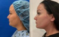 Woman treated with Chin Liposuction