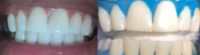 35-44 year old woman treated with Zoom Whitening