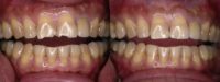 Cosmetic bonding of two front teeth
