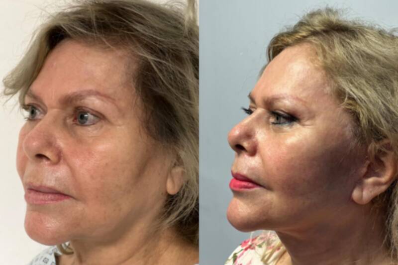 45-54 year old woman treated with Deep Plane Facelift, Facelift, SMAS Facelift, Lower Facelift