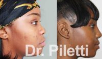 18-24 year old woman treated with African American Rhinoplasty