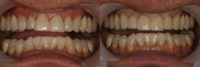 55-64 year old man treated with Smile Makeover