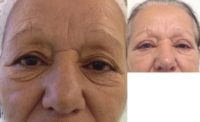 65-74 year old woman treated with Eyelid Surgery