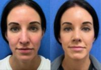 Wooman treated with Rhinoplasty