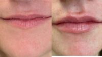 18-24 year old woman treated with Lip Fillers