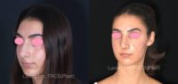 18-24 year old woman treated with Rhinoplasty