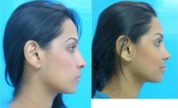 18-24 year old woman treated with Rhinoplasty