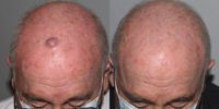 65-74 year old man treated with Mole Removal