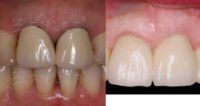 35-44 year old woman treated with Dental Crown
