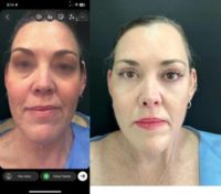 35-44 year old woman treated with Facelift