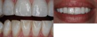 25-34 year old woman treated with Cosmetic Dentistry