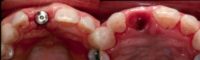 Gum Graft Around Implant