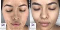 25-34 year old woman treated with Skin Rejuvenation