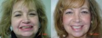 Implant supported full dentures