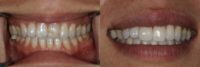 Porcelain veneers to correct stained and chipped front teeth
