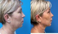 56 year old  -  Submental Neck Lift with LipoRF/Structural Fat Grafting to upper lids/Laser Resurfacing to Lower Face