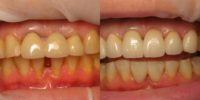 55-64 year old woman treated with Porcelain Veneers and Porcelain bridge