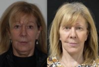 Woman treated with Lower Facelift