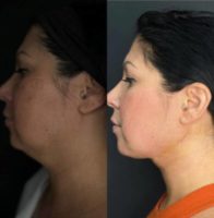 Woman treated with Neck Lift