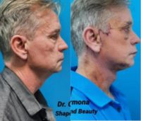 Man treated with Facelift