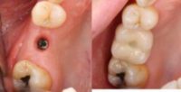 35-44 year old man treated with Dental Implants