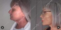 Woman treated with Facelift