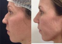 25-34 year old woman treated with Rhinoplasty