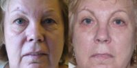 60 year old woman treated with Eyelid Surgery (Blehaproplasty)