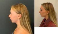 18-24 year old woman treated with Rhinoplasty